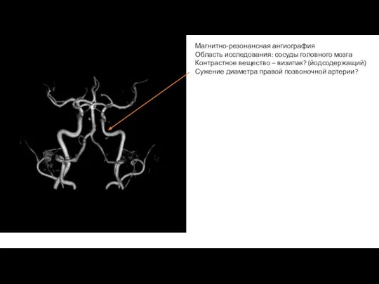 Магнитно-резонансная ангиография Область исследования: сосуды головного мозга Контрастное вещество – визипак? (йодсодержащий)