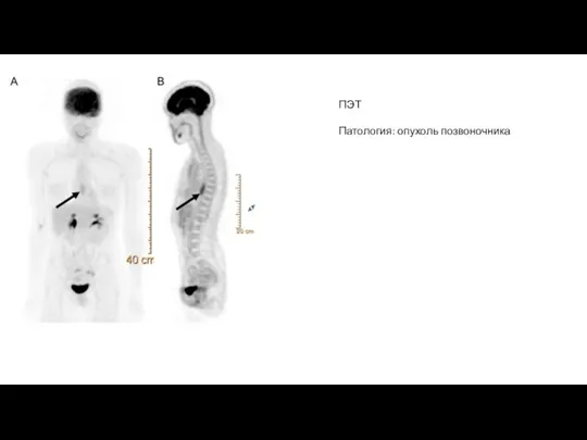 ПЭТ Патология: опухоль позвоночника
