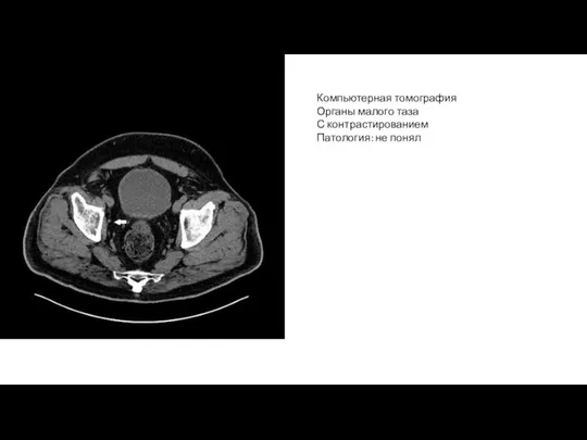 Компьютерная томография Органы малого таза С контрастированием Патология: не понял
