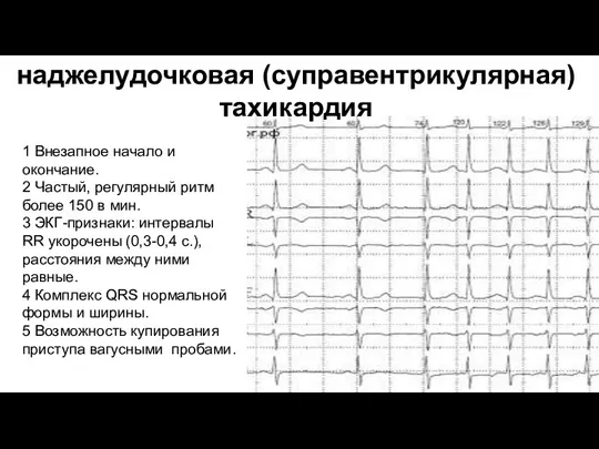 наджелудочковая (суправентрикулярная) тахикардия 1 Внезапное начало и окончание. 2 Частый, регулярный ритм