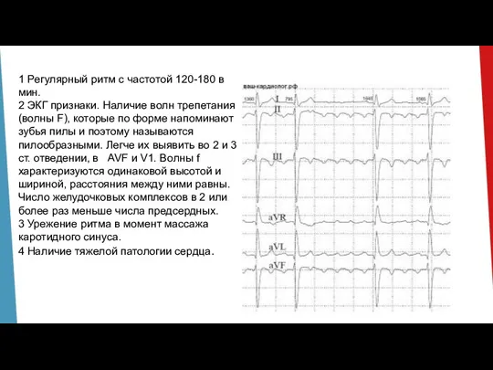 1 Регулярный ритм с частотой 120-180 в мин. 2 ЭКГ признаки. Наличие