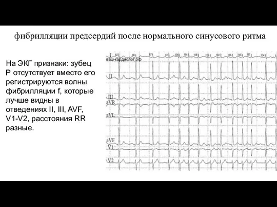 фибрилляции предсердий после нормального синусового ритма На ЭКГ признаки: зубец Р отсутствует