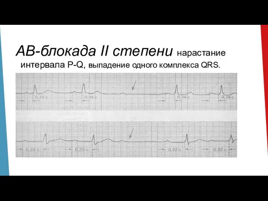 АВ-блокада II степени нарастание интервала P-Q, выпадение одного комплекса QRS.