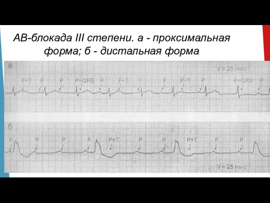 АВ-блокада III степени. а - проксимальная форма; б - дистальная форма