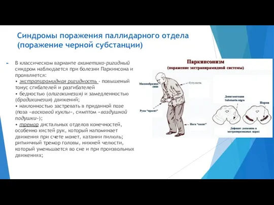 Синдромы поражения паллидарного отдела (поражение черной субстанции) В классическом варианте акинетико-ригидный синдром