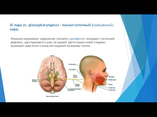 IX пара (n. glossopharyngeus) - языкоглоточный (смешанный) нерв. Клиника поражения: нарушение глотания