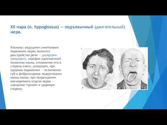 XII пара (n. hypoglossus) — подъязычный (двигательный) нерв. Клиника: ведущими симптомами поражения