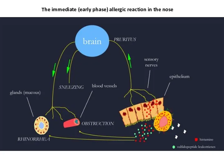 The immediate (early phase) allergic reaction in the nose