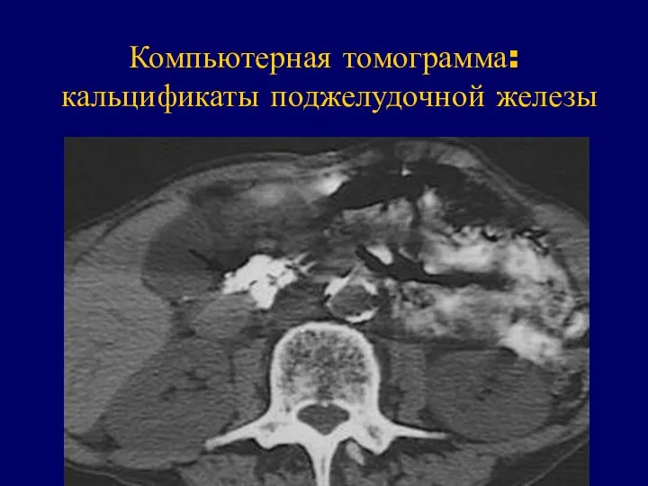 Компьютерная томограмма: кальцификаты поджелудочной железы