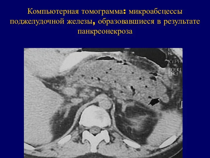 Компьютерная томограмма: микроабсцессы поджелудочной железы, образовавшиеся в результате панкреонекроза