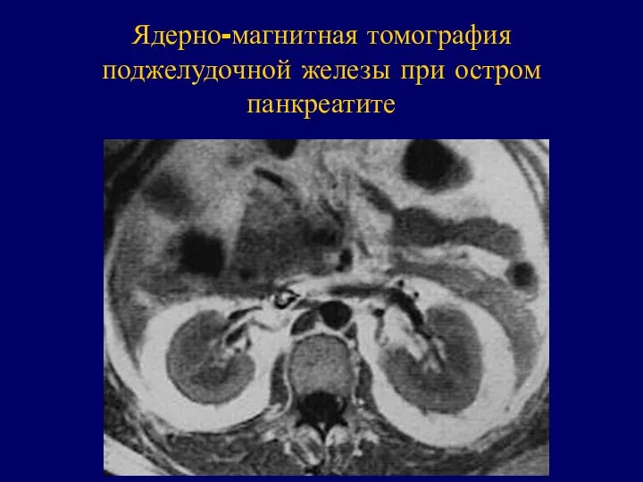 Ядерно-магнитная томография поджелудочной железы при остром панкреатите