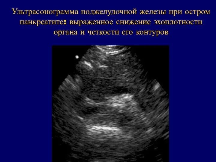 Ультрасонограмма поджелудочной железы при остром панкреатите: выраженное снижение эхоплотности органа и четкости его контуров