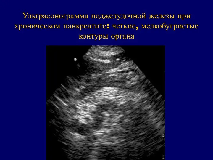 Ультрасонограмма поджелудочной железы при хроническом панкреатите: четкие, мелкобугристые контуры органа