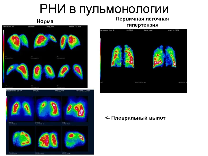 РНИ в пульмонологии Норма Первичная легочная гипертензия