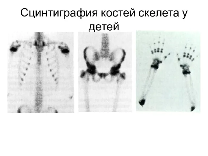 Сцинтиграфия костей скелета у детей