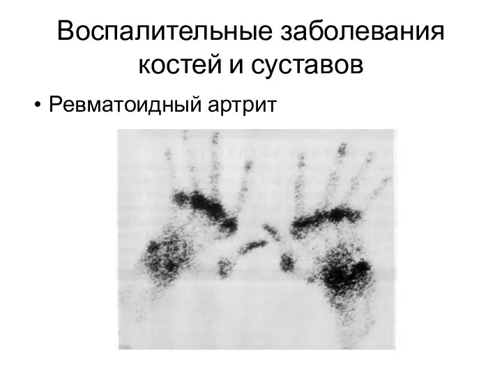 Воспалительные заболевания костей и суставов Ревматоидный артрит