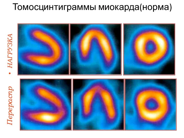 Томосцинтиграммы миокарда(норма) НАГРУЗКА Перераспр