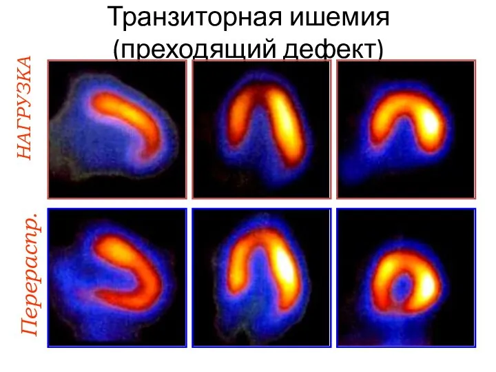 Транзиторная ишемия (преходящий дефект) НАГРУЗКА Перераспр.