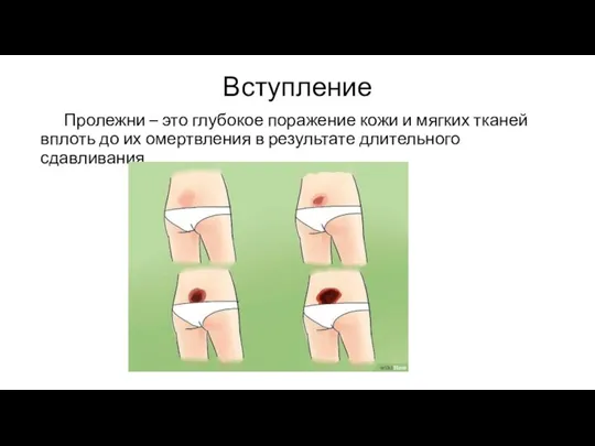 Вступление Пролежни – это глубокое поражение кожи и мягких тканей вплоть до