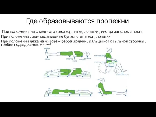 Где образовываются пролежни При положении на спине - это крестец , пятки,