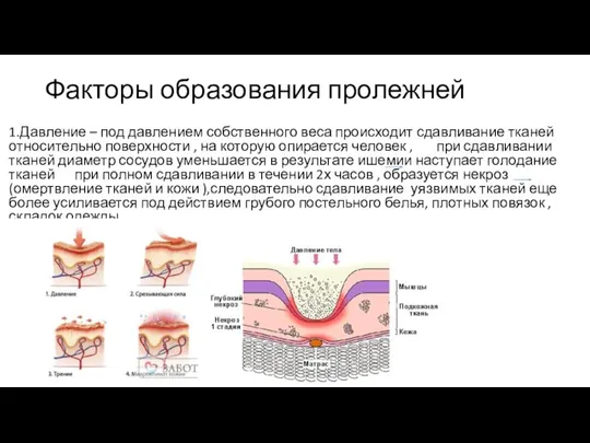 Факторы образования пролежней 1.Давление – под давлением собственного веса происходит сдавливание тканей