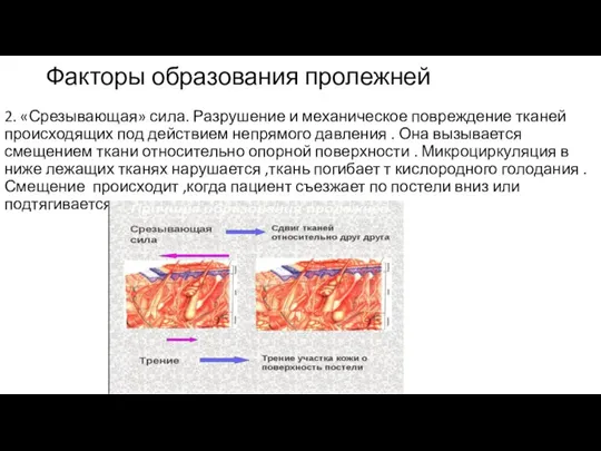 Факторы образования пролежней 2. «Срезывающая» сила. Разрушение и механическое повреждение тканей происходящих