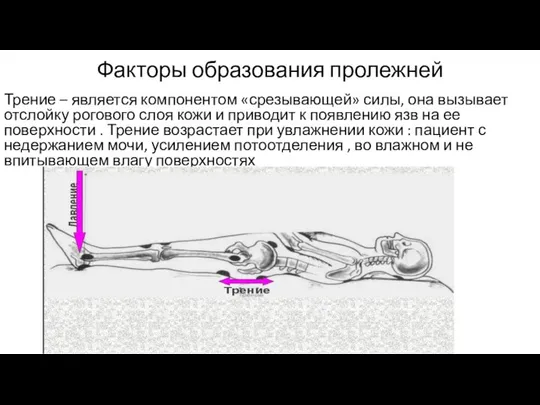 Факторы образования пролежней Трение – является компонентом «срезывающей» силы, она вызывает отслойку