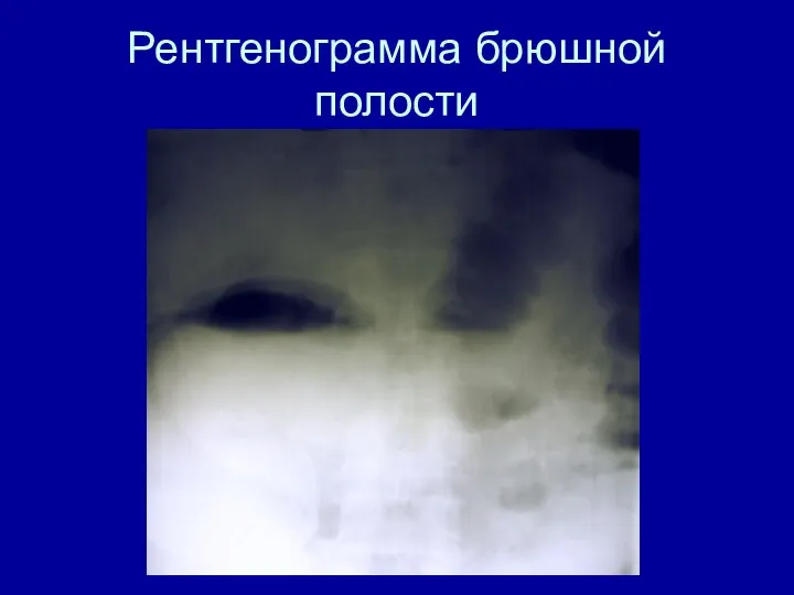 Рентгенограмма брюшной полости