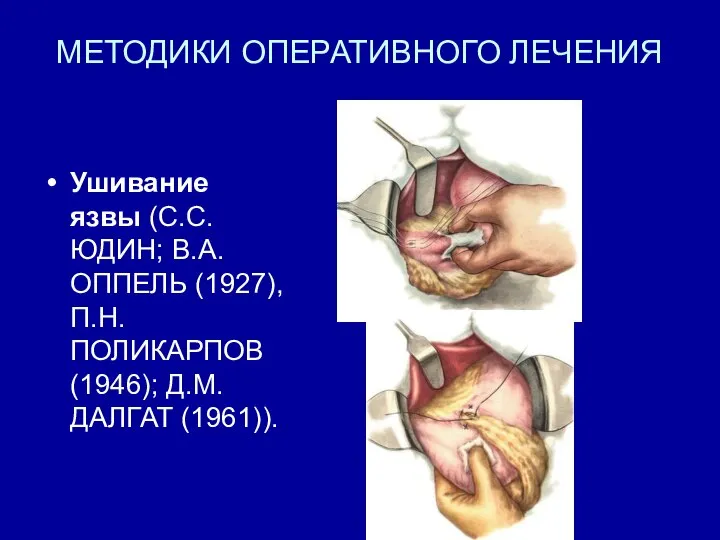 МЕТОДИКИ ОПЕРАТИВНОГО ЛЕЧЕНИЯ Ушивание язвы (С.С. ЮДИН; В.А. ОППЕЛЬ (1927), П.Н. ПОЛИКАРПОВ (1946); Д.М. ДАЛГАТ (1961)).