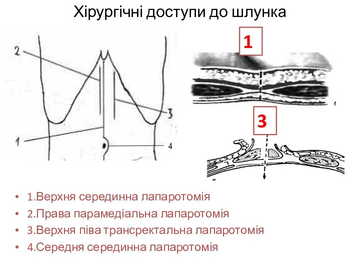 Хірургічні доступи до шлунка 1.Верхня серединна лапаротомія 2.Права парамедіальна лапаротомія 3.Верхня піва