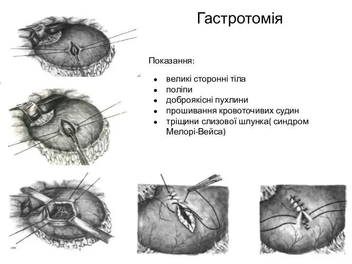 Гастротомія Показання: великі сторонні тіла поліпи доброякісні пухлини прошивання кровоточивих судин тріщини слизової шлунка( синдром Мелорі-Вейса)