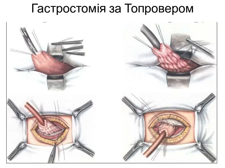 Гастростомія за Топровером