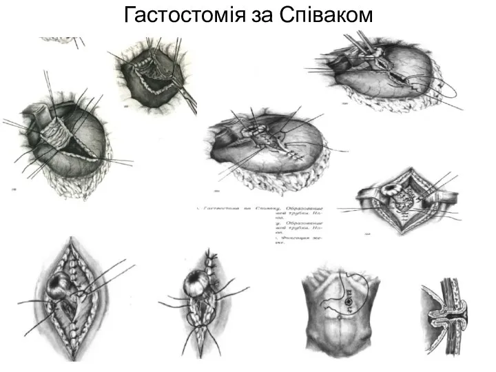 Гастостомія за Співаком