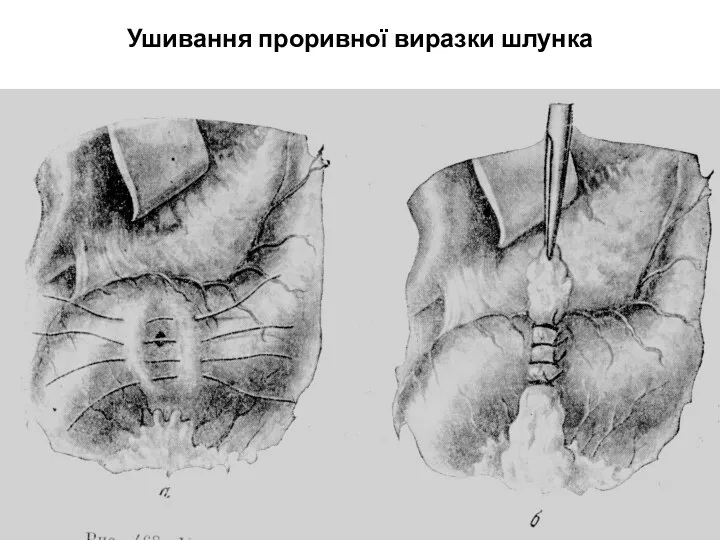 Ушивання проривної виразки шлунка