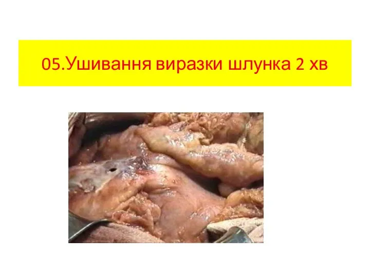 05.Ушивання виразки шлунка 2 хв