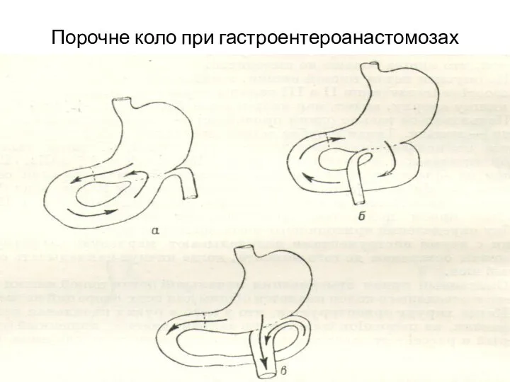 Порочне коло при гастроентероанастомозах