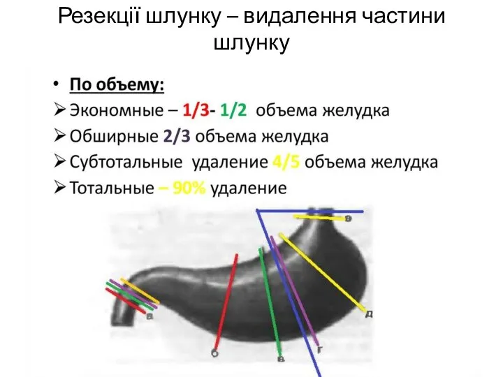 Резекції шлунку – видалення частини шлунку