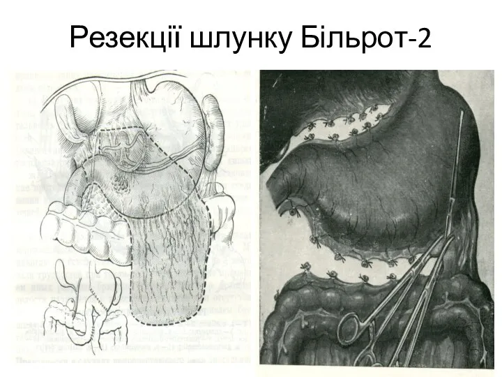 Резекції шлунку Більрот-2