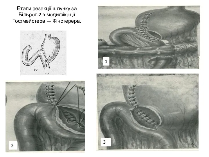 Етапи резекції шлунку за Більрот-2 в модифікації Гофмейстера — Фінстерера. 1 2 3