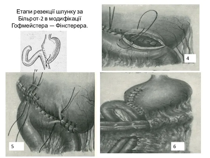 Етапи резекції шлунку за Більрот-2 в модифікації Гофмейстера — Фінстерера. 4 5 6