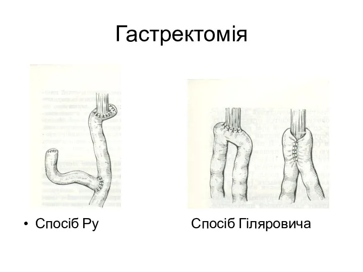 Гастректомія Спосіб Ру Спосіб Гіляровича