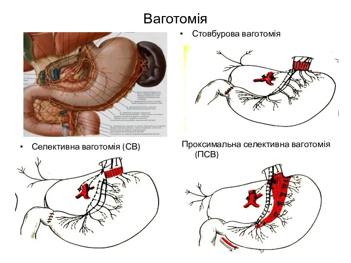 Ваготомія Стовбурова ваготомія Селективна ваготомія (СВ) Проксимальна селективна ваготомія (ПСВ)