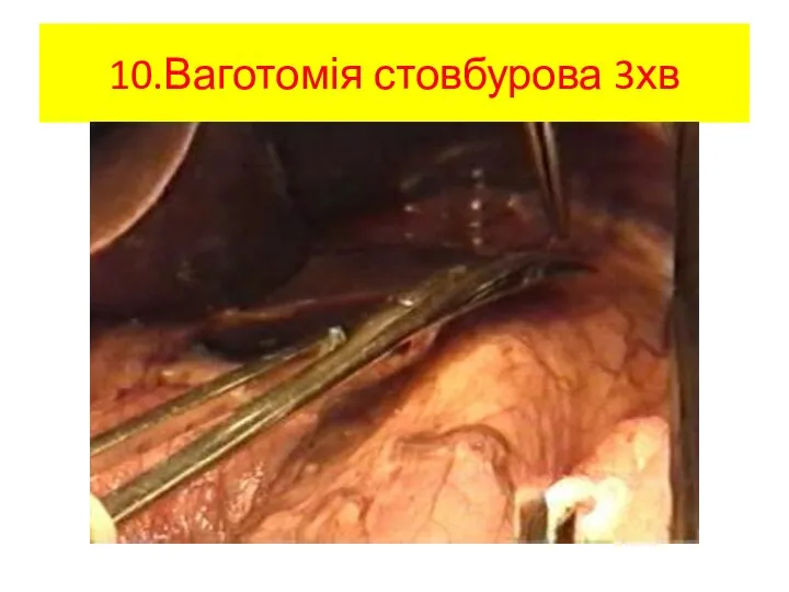 10.Ваготомія стовбурова 3хв