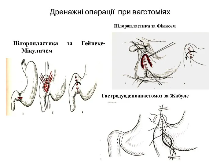 Дренажні операції при ваготоміях Пілоропластика за Гейнеке-Мікуличем Пілоропластика за Фіннеєм Гастродуоденоанастомоз за Жабуле