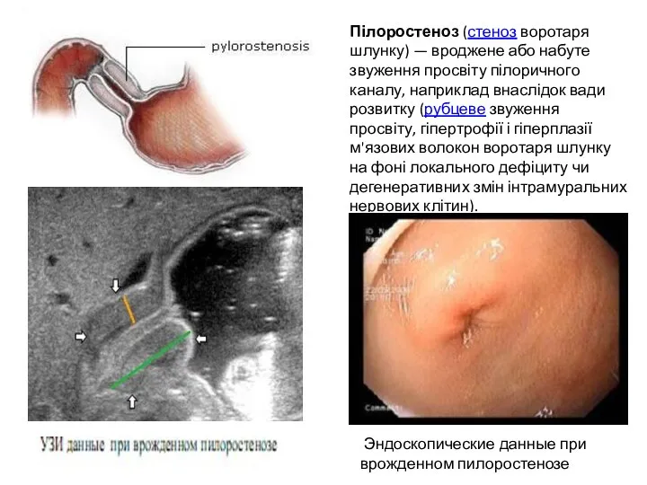 Пілоростеноз (стеноз воротаря шлунку) — вроджене або набуте звуження просвіту пілоричного каналу,