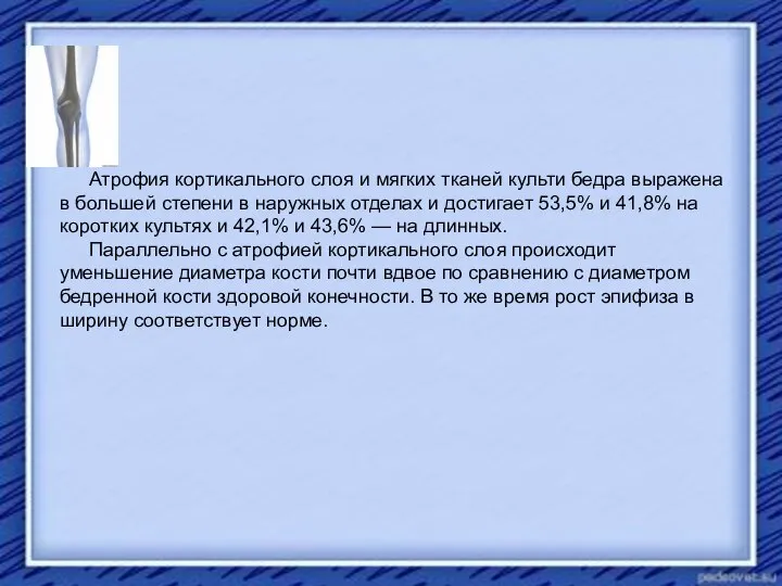 Атрофия кортикального слоя и мягких тканей культи бедра выражена в большей степени