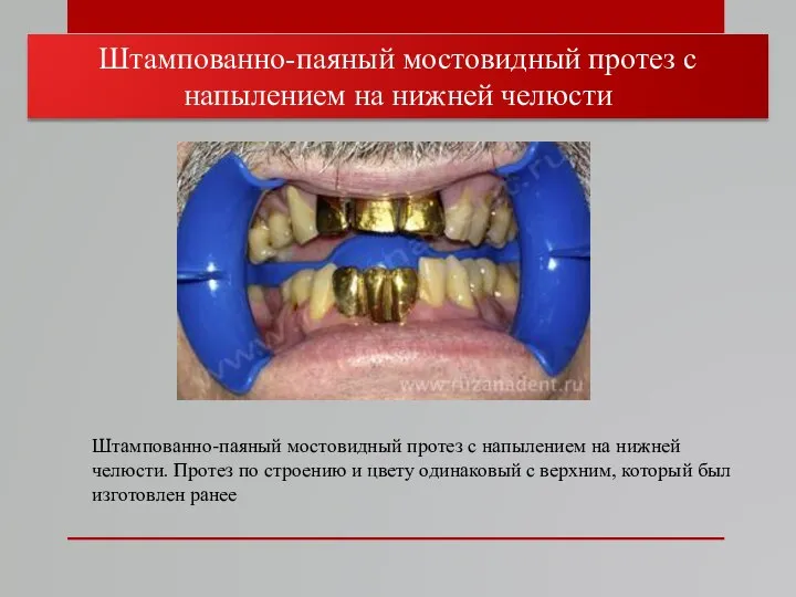 Штампованно-паяный мостовидный протез с напылением на нижней челюсти. Протез по строению и