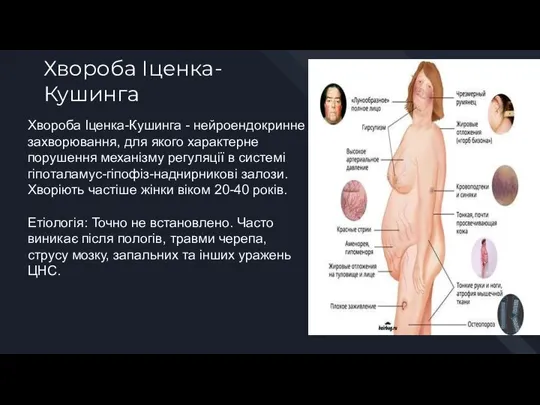 Хвороба Іценка-Кушинга Хвороба Іценка-Кушинга - нейроендокринне захворювання, для якого характерне порушення механізму