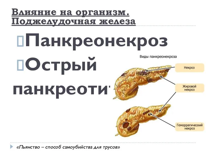 Панкреонекроз Острый панкреотит Влияние на организм. Поджелудочная железа «Пьянство – способ самоубийства для трусов»