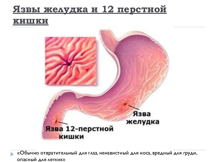 Язвы желудка и 12 перстной кишки «Обычно отвратительный для глаз, ненавистный для